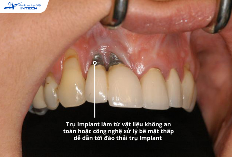 Trụ Implant làm từ vật liệu kém chất lượng hoặc xử lý bề mặt không tinh vi có thể dẫn tới đào thải trụ do khả năng tương thích sinh học thấp