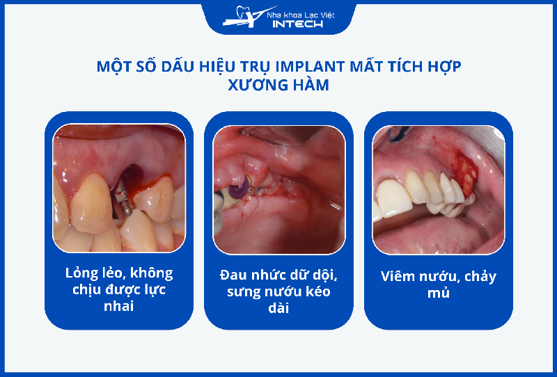 Trụ Implant mất tích hợp có thể do chất lượng trụ không tốt hoặc kỹ thuật cấy ghép không đúng