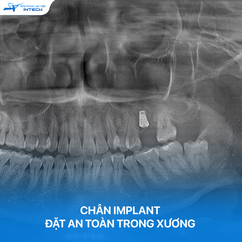 Trụ Implant mô phỏng cấu trúc chân răng thật của người, ngăn ngừa tiêu xương hàm khi bị mất răng