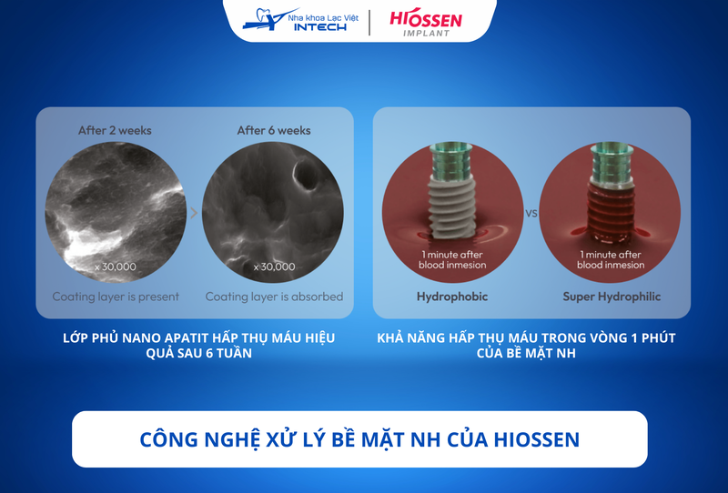 Công nghệ xử lý bề mặt đời mới NH được cải tiến từ SA, bổ sung khả năng ưa nước giúp hấp thụ máu nhanh hơn