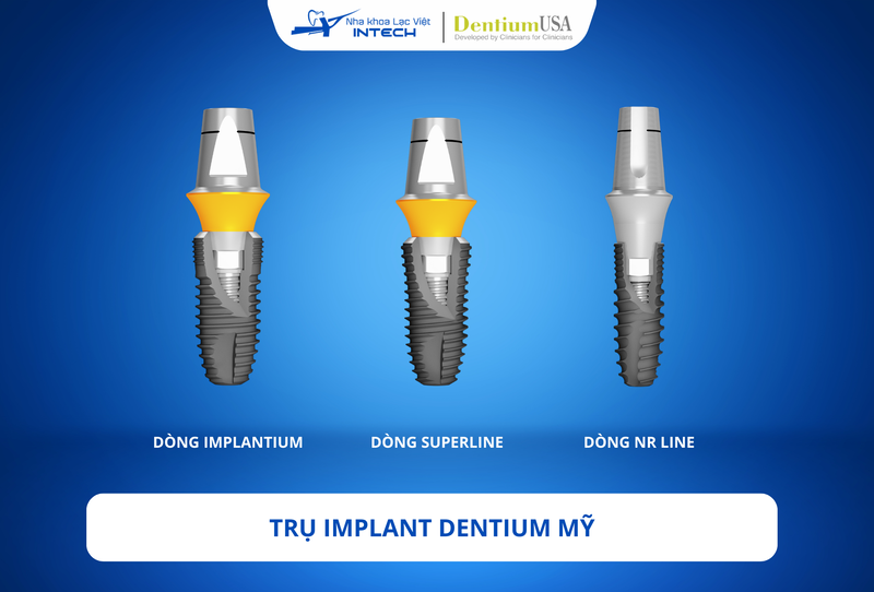 4 loại trụ Implant Mỹ chất lượng kèm bảng giá mới nhất 2025