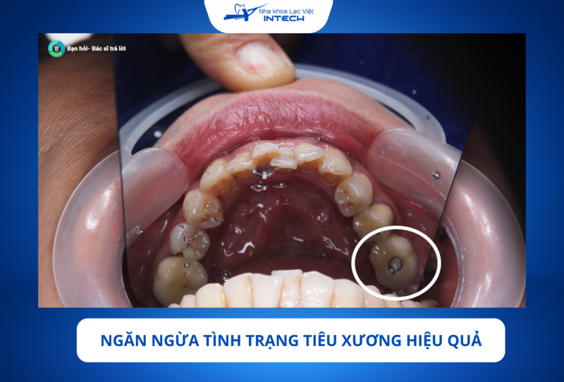 Trụ Implant Neodent giúp tích hợp vững chắc và thay thế chân răng đã mất