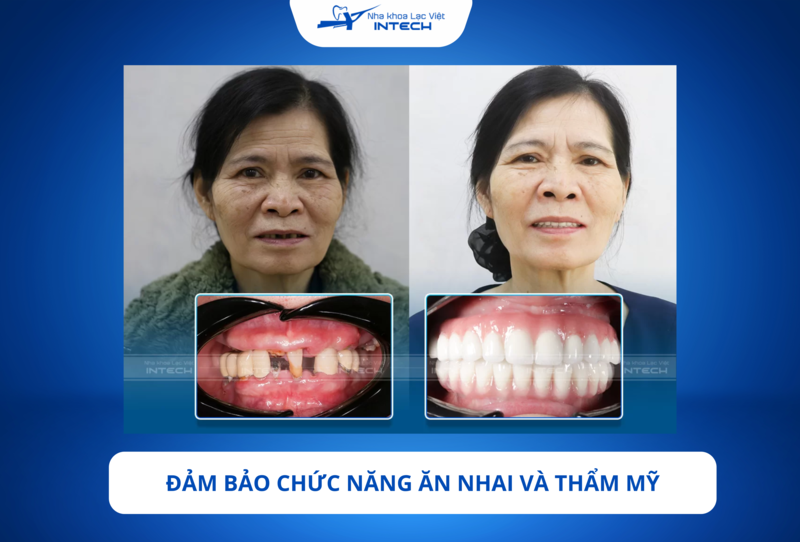 Trụ làm từ Zirconia màu trắng, khả năng thẩm mỹ được nâng cao