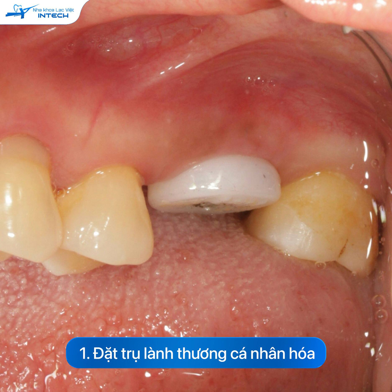 Trụ lành thương được đặt sau khi cấy trụ Implant, tạo điều kiện cho lợi lành thương