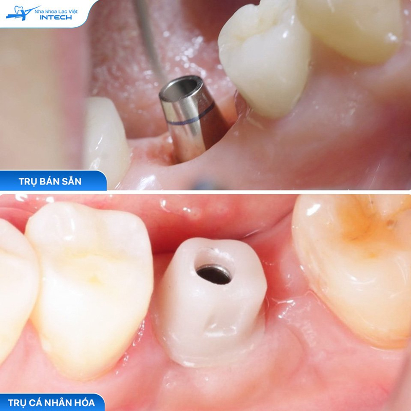 Trụ phục hình cá nhân hóa có độ khít sát nướu vượt trội hơn, ngăn chặn các vấn đề giắt thức ăn gây tích tụ vi khuẩn, mảng bám