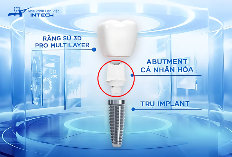 Trụ phục hình là khớp nối giữa chân Implant với mão răng sứ