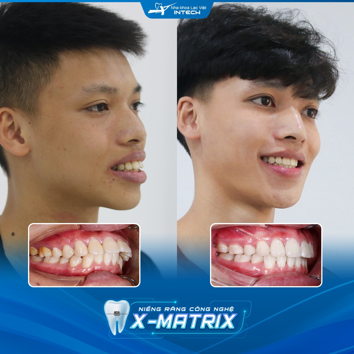Sự thay đổi niềng răng hô
