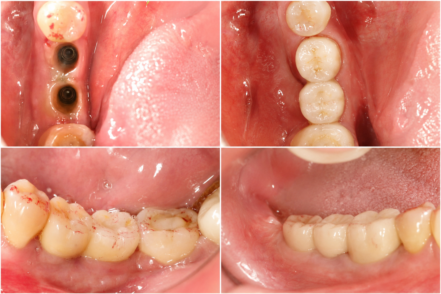 Hình ảnh kết quả phục hình Implant cá nhân hóa vùng răng cửa do Bác sĩ Nguyễn Ngọc Bảo trực tiếp điều trị