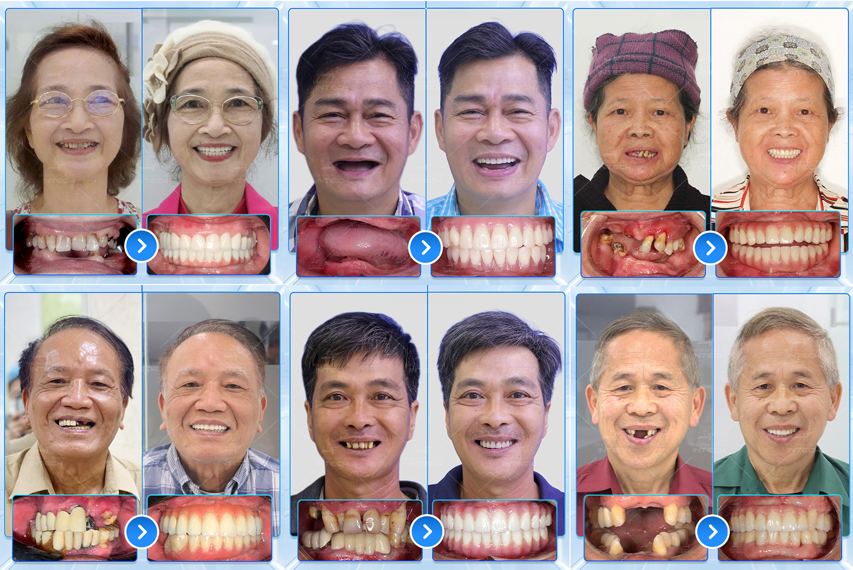 Nha khoa Lạc Việt Intech mang đến nụ cười mới cho nhiều khách hàng mất răng.