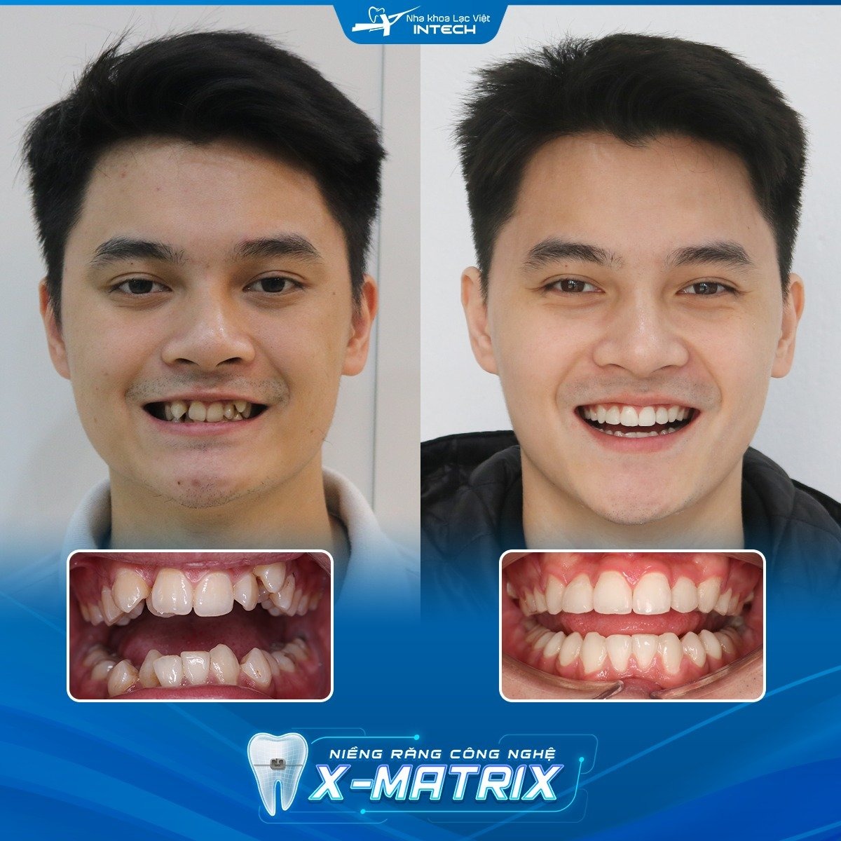 QUy trình niềng răng khấp khểnh, chen chúc 