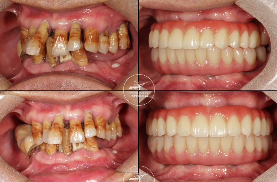 Bác sĩ Trịnh Minh Chiến cũng có nhiều ca trồng răng Implant thay đổi ấn tượng.