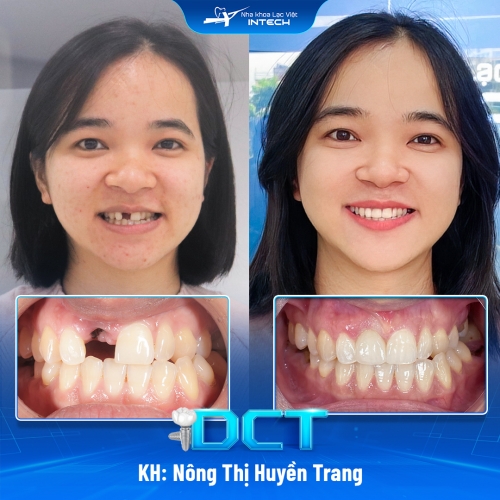 KH: Nông Thị Huyền Trang