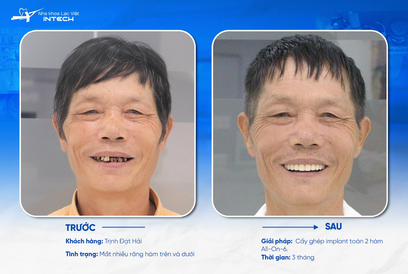 Các trường hợp nào có thể cấy ghép Implant đảm bảo an toàn 