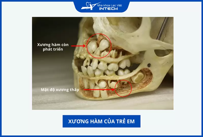 Trồng răng Implant thường không được khuyến cáo cho người chưa đủ 18 tuổi