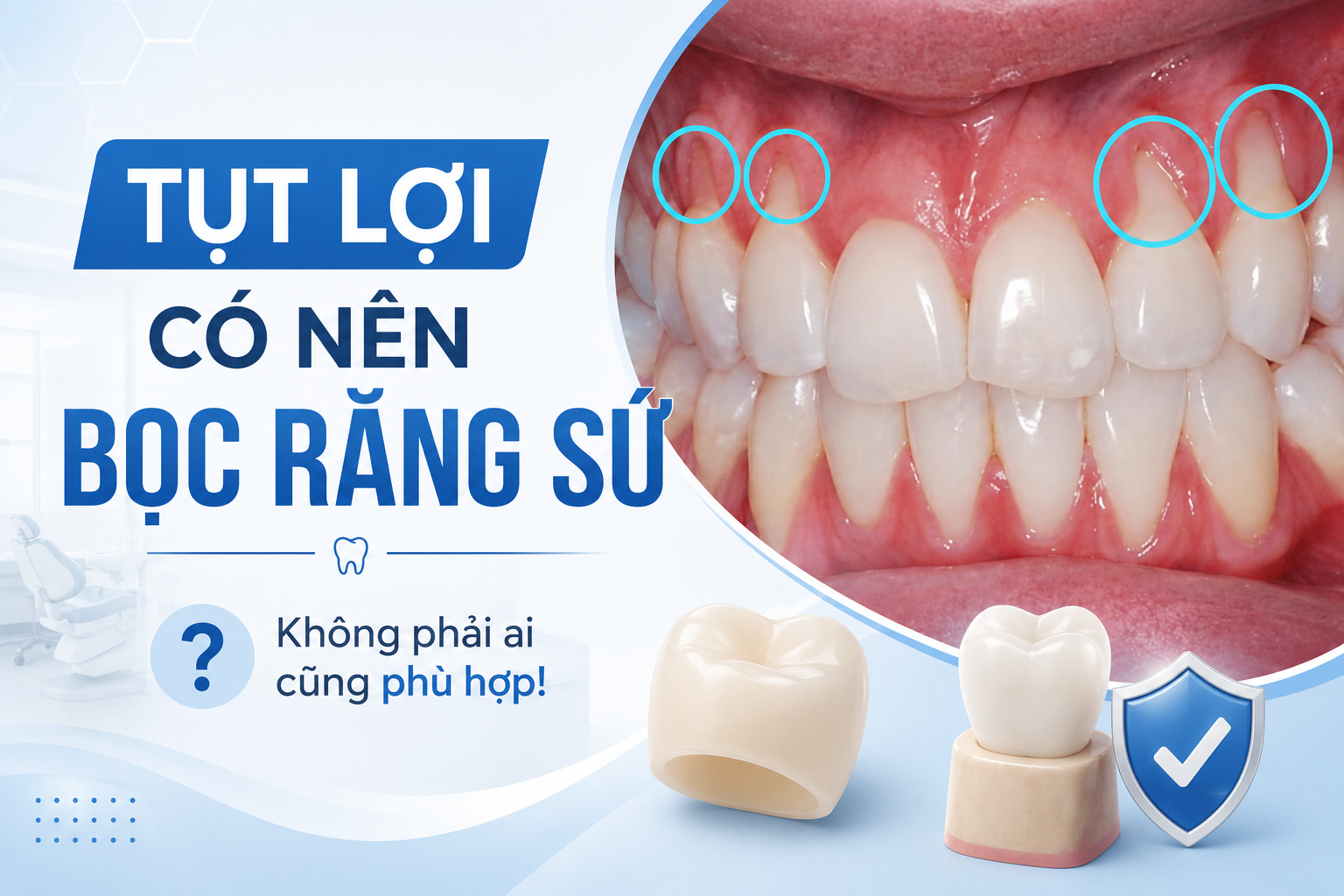 Tụt lợi có nên bọc răng sứ không? Góc nhìn từ chuyên gia phục hình và nha chu