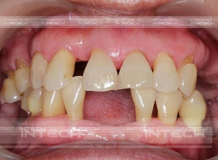 Tụt nướu răng gây nên nguy cơ mất răng 