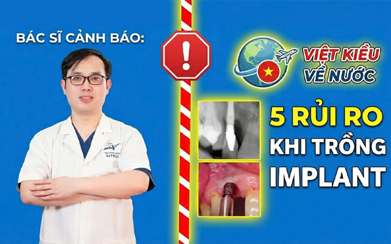 Việt kiều về Việt Nam làm răng Implant: 5 rủi ro cần biết trước khi quyết định