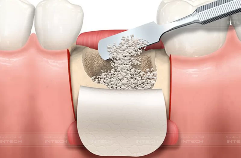 Quy trình trồng răng Implant cho người mất răng lâu năm có thể cần thực hiện một số thủ thuật như nâng xoang hoặc ghép xương