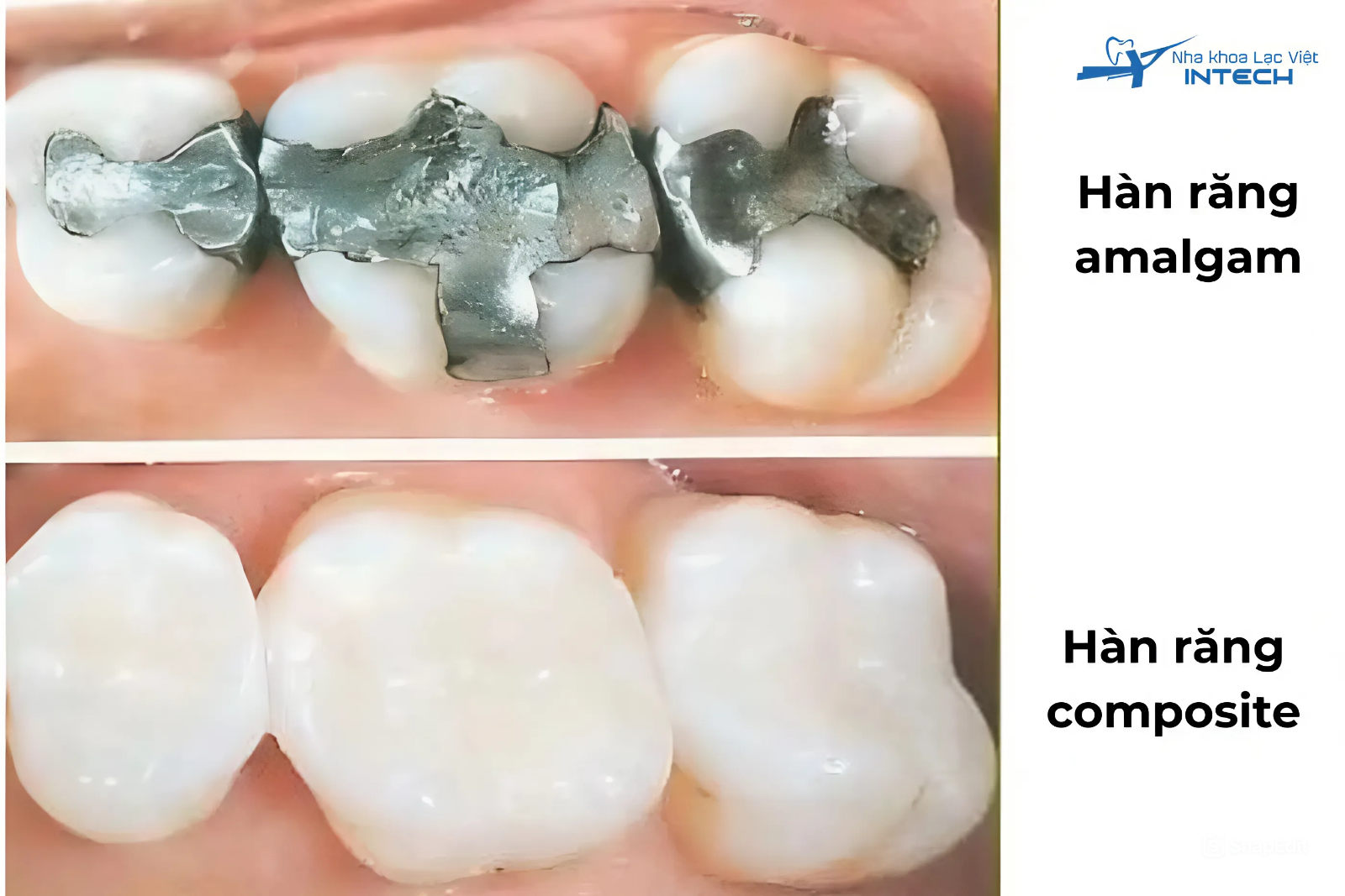 Việc lựa chọn vật liệu hàn răng phù hợp sẽ phụ thuộc vào vị trí răng cần điều trị, yêu cầu thẩm mỹ, ngân sách và mục đích sử dụng