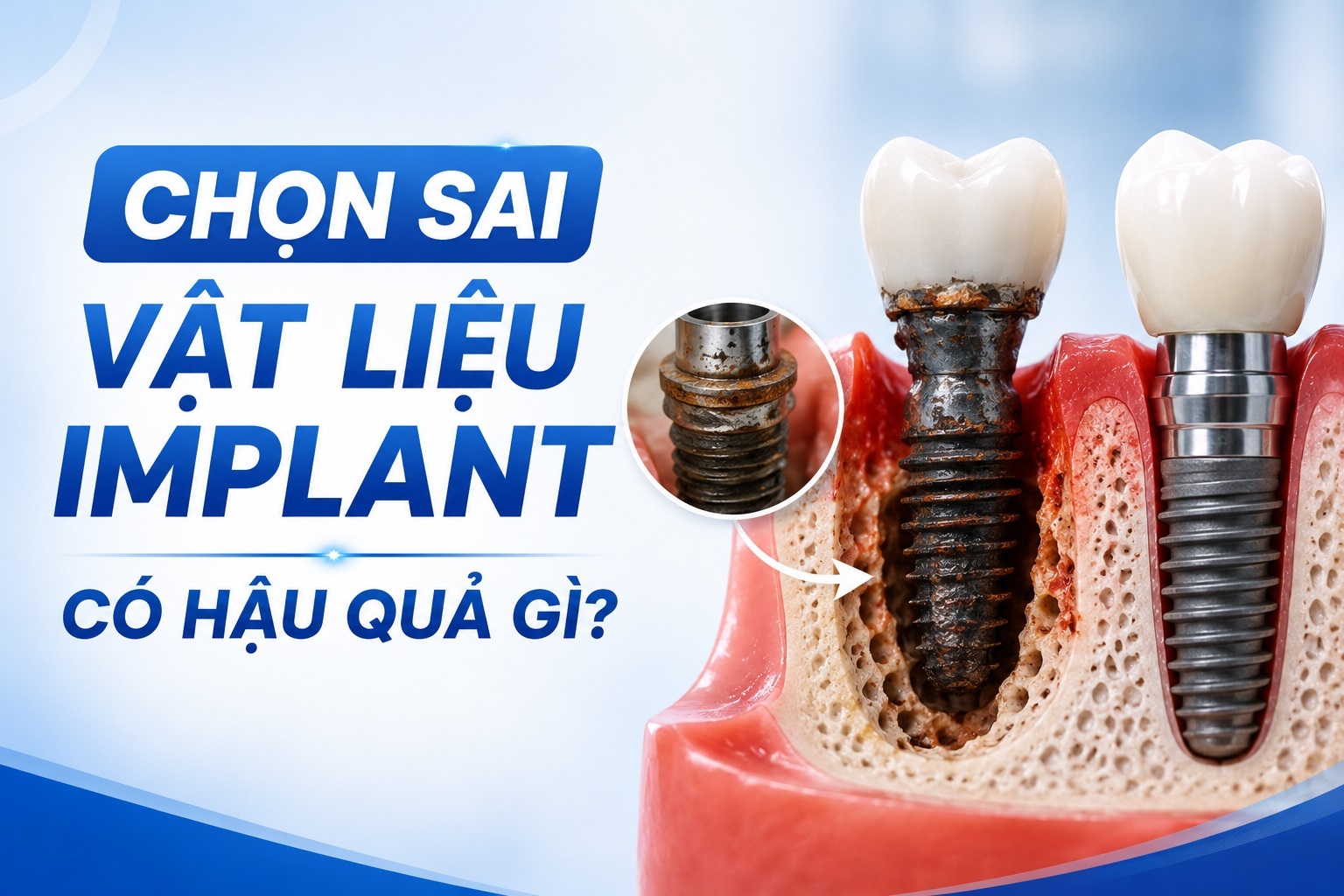 Chọn sai vật liệu Implant có hậu quả gì? Phân tích chi tiết từng bộ phận và vật liệu