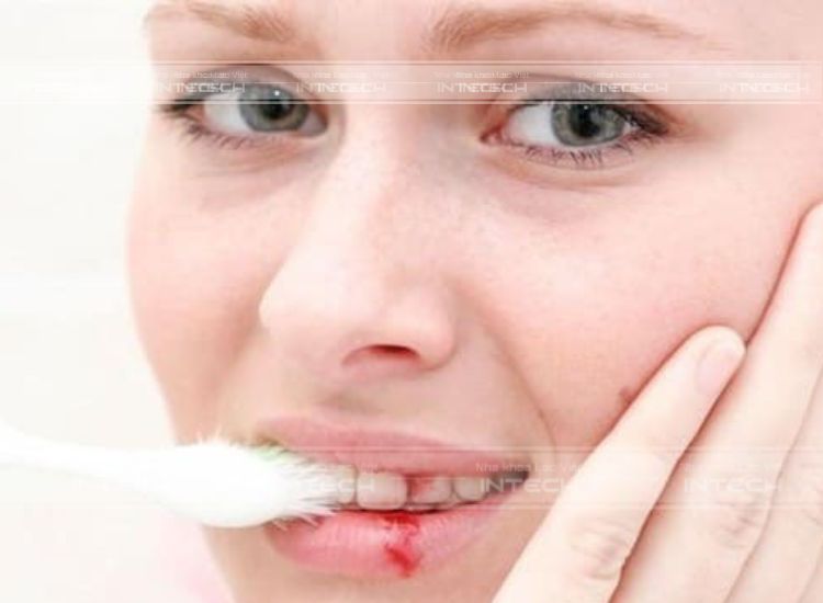 Vệ sinh răng miệng không đúng cách sẽ dẫn đến áp xe răng khôn