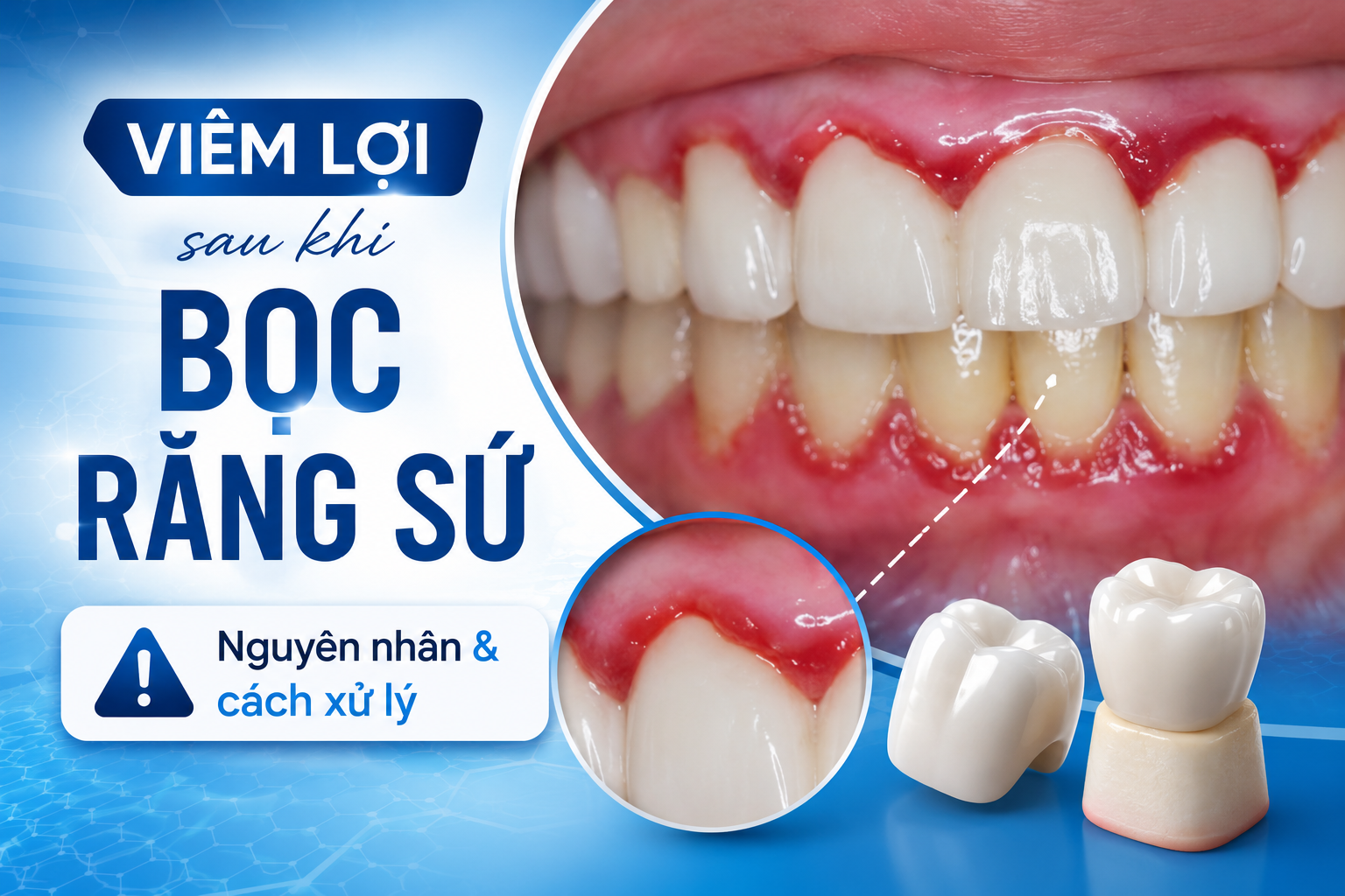 Bọc răng sứ bị viêm lợi phải làm sao? 10 nguyên nhân thường gặp và cách điều trị hiệu quả nhất