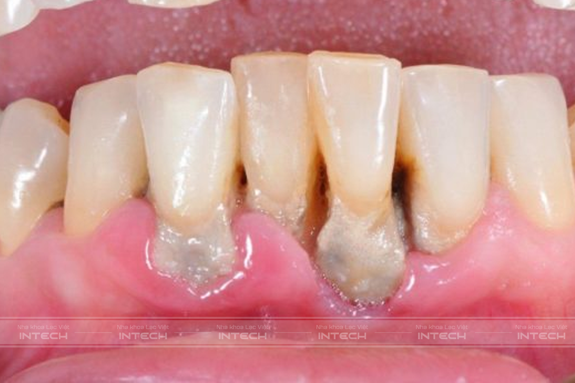 Viêm quanh răng có thể gây rụng răng