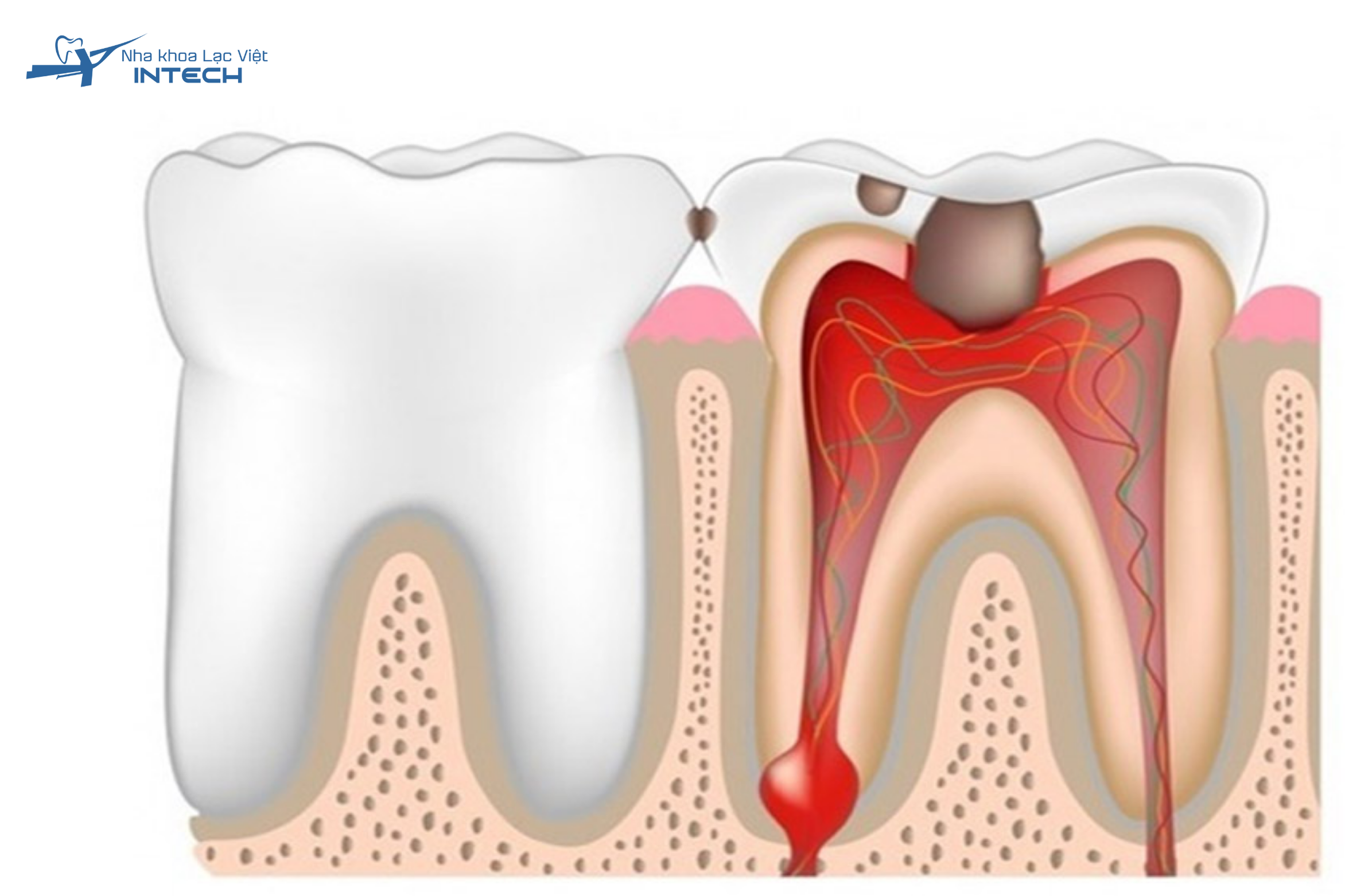 Lấy tủy răng (hay điều trị tủy) là quá trình loại bỏ phần tủy bị viêm nhiễm khỏi ống tủy, sau đó làm sạch, khử khuẩn và trám bít ống tủy lại để ngăn ngừa tái nhiễm