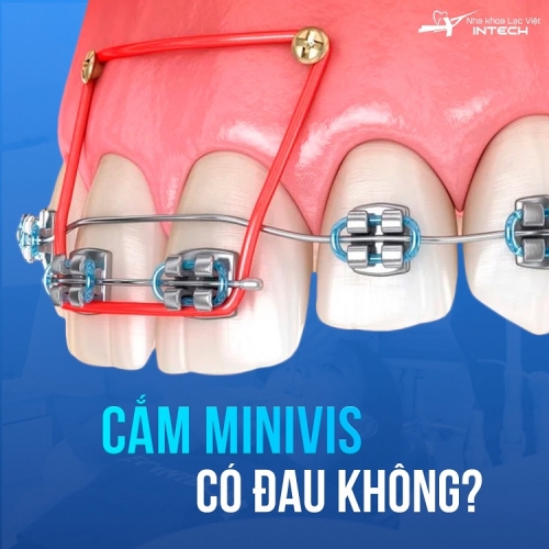 VÌ SAO PHẢI CẮM VÍT NIỀNG RĂNG? CẮM VÍT NIỀNG RĂNG CÓ ĐAU KHÔNG?