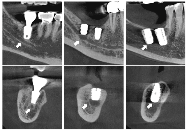 Vị trí đặt trụ cấy ghép có nguy cơ xâm phạm dây thần kinh răng dưới (mũi tên).