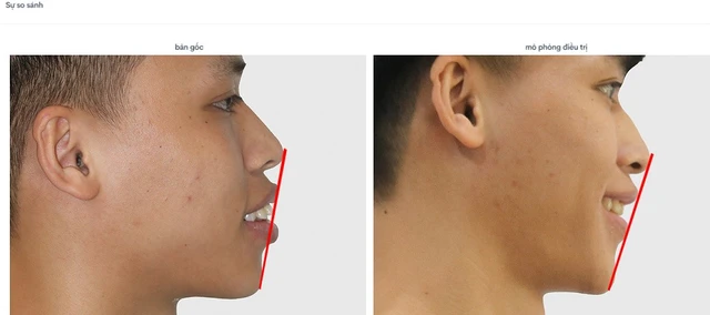 Xem trước kết quả niềng răng tại nha khoa uy tín Hải Phòng.