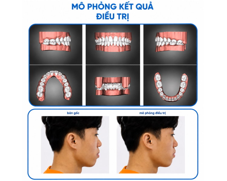 Xem trước kết quả niềng răng - đột phá công nghệ tại Lạc Việt Intech.