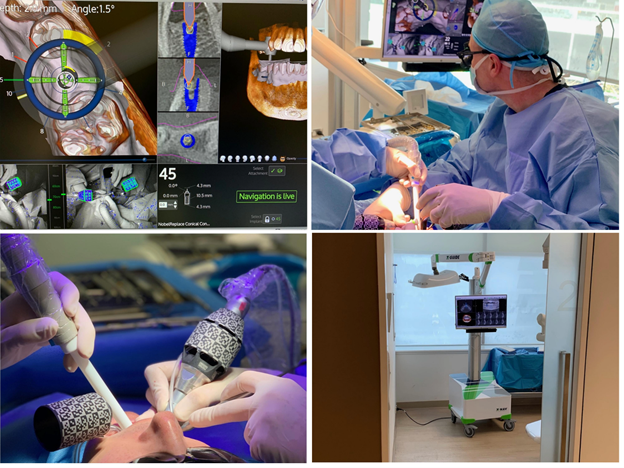 Cấy implant bằng định vị Xguide