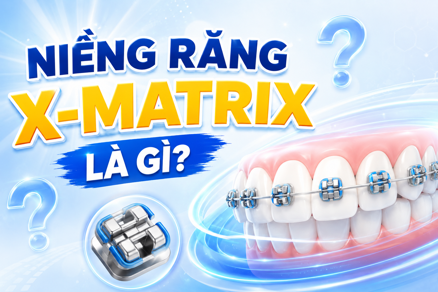 Giải pháp niềng răng X-Matrix là gì? Vì sao được xem là bước tiến quan trọng trong chỉnh nha hiện đại