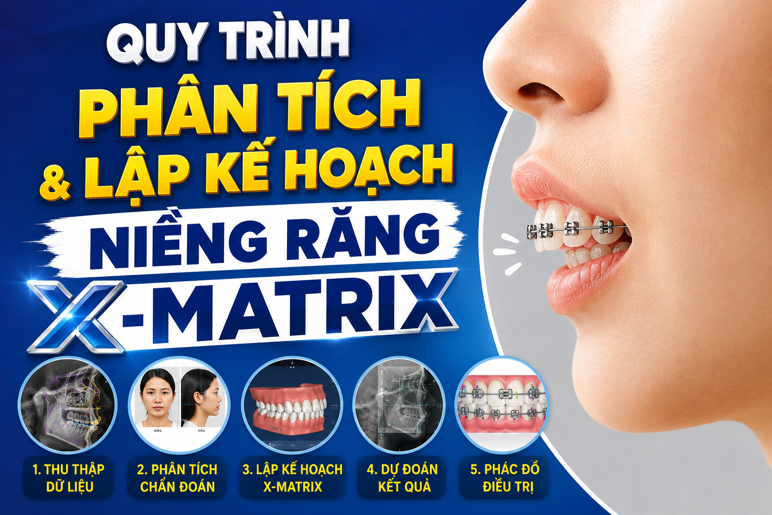 Quy trình phân tích và lập kế hoạch niềng răng X-matrix tại Lạc Việt Intech