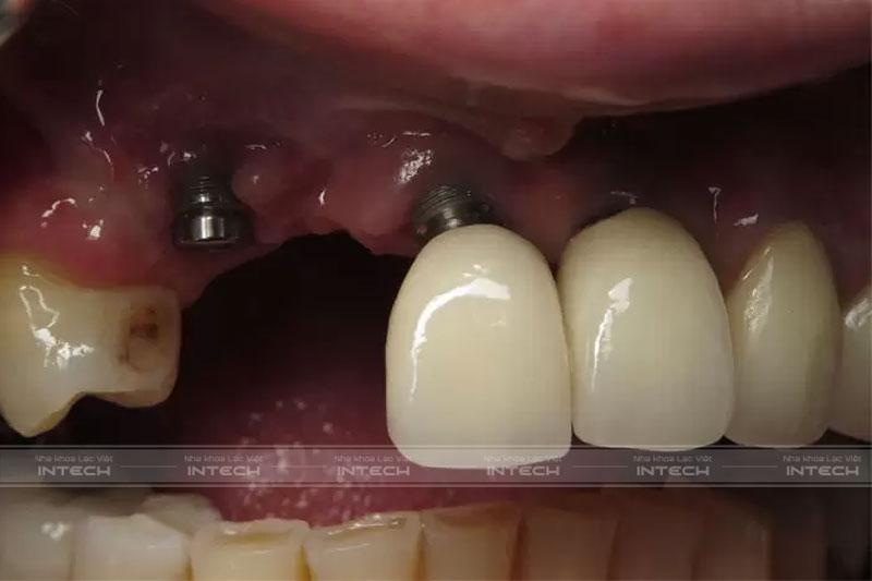Có rất nhiều yếu tố ảnh hưởng tới tuổi thọ của răng Implant